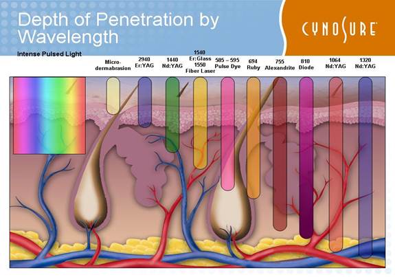 Skin penetration depth of 3khz