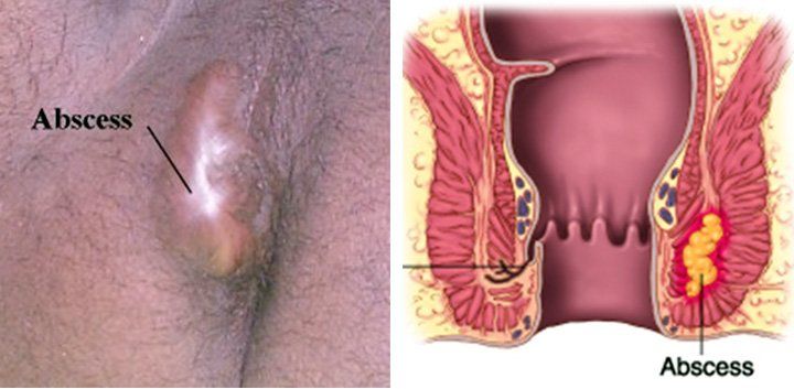 Shrink cyst near anus