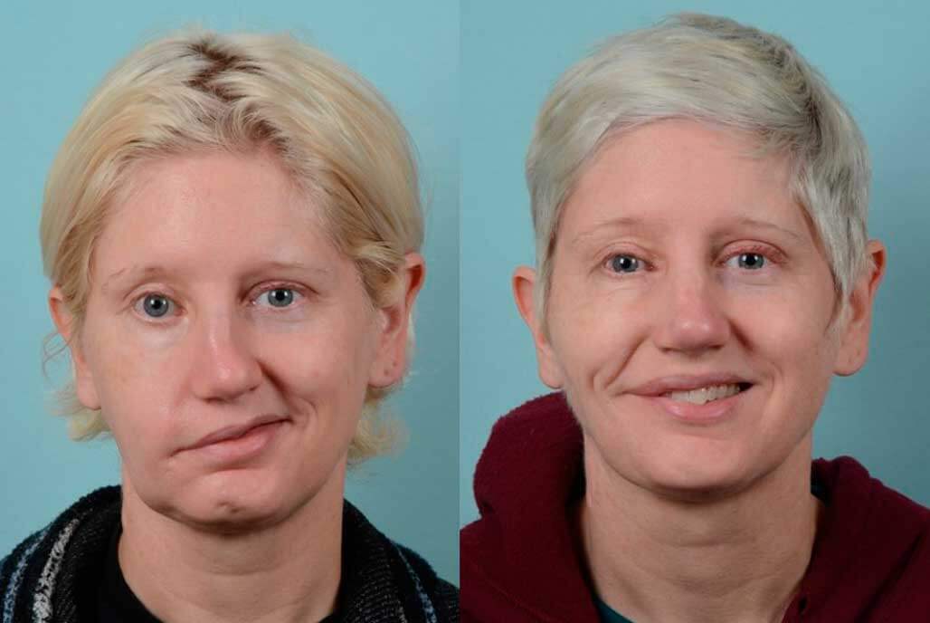 Trinity reccomend Facial reanimation without surgery