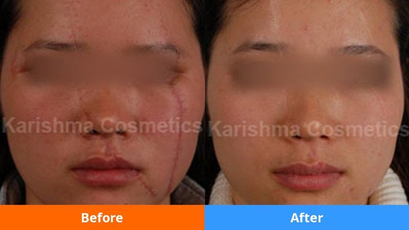 best of Facial acne Reducing scarring from