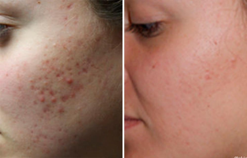 Reducing facial scarring from acne