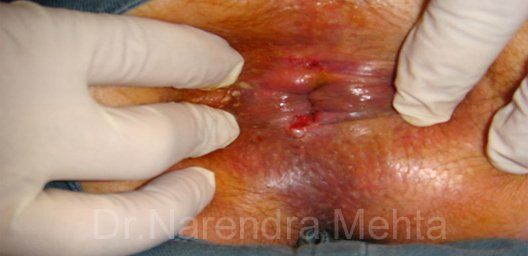 best of Anal not tear blisters herpes Trauma