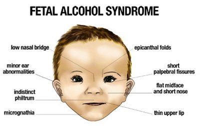 Fetal alcohol syndrome diagnose facial