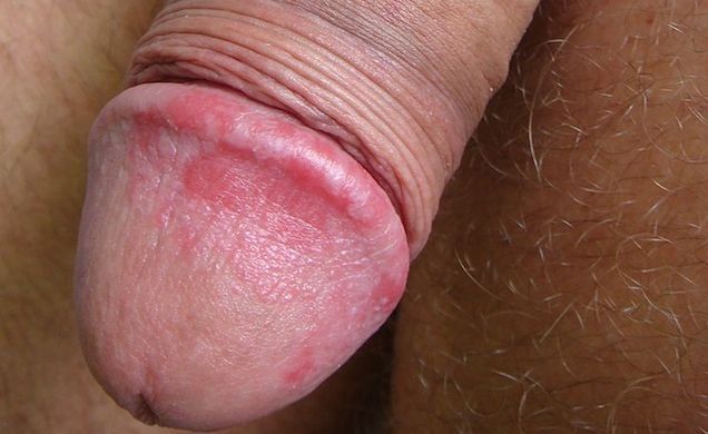 Whisky G. reccomend Red marks after masturbation