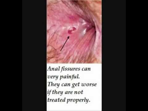 Red S. reccomend Anal fissures and thin stools