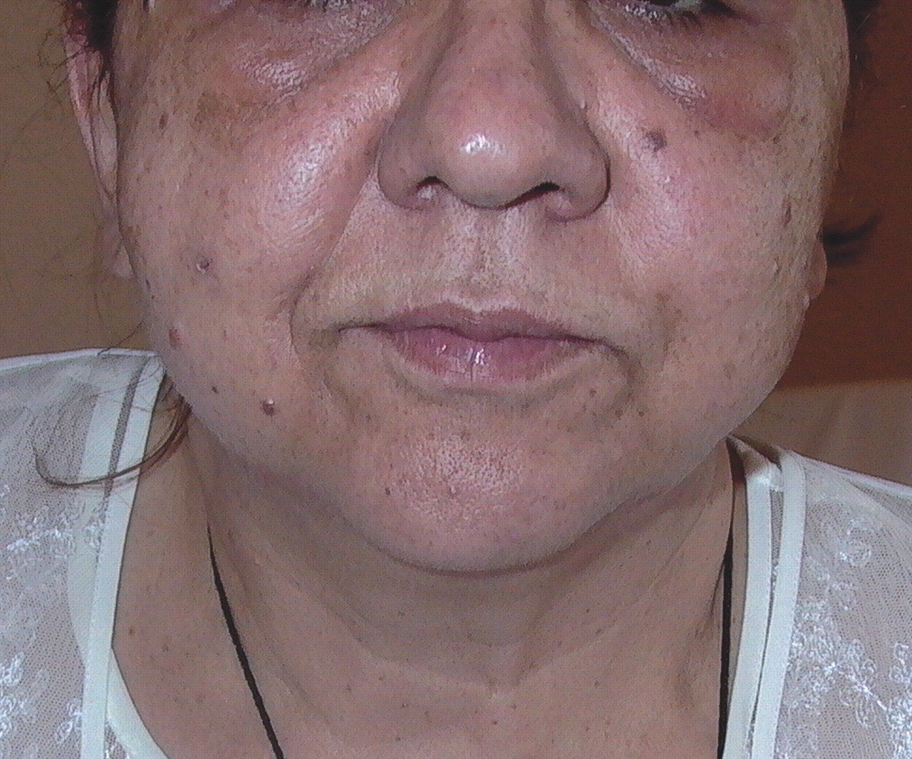 best of Edema And facial