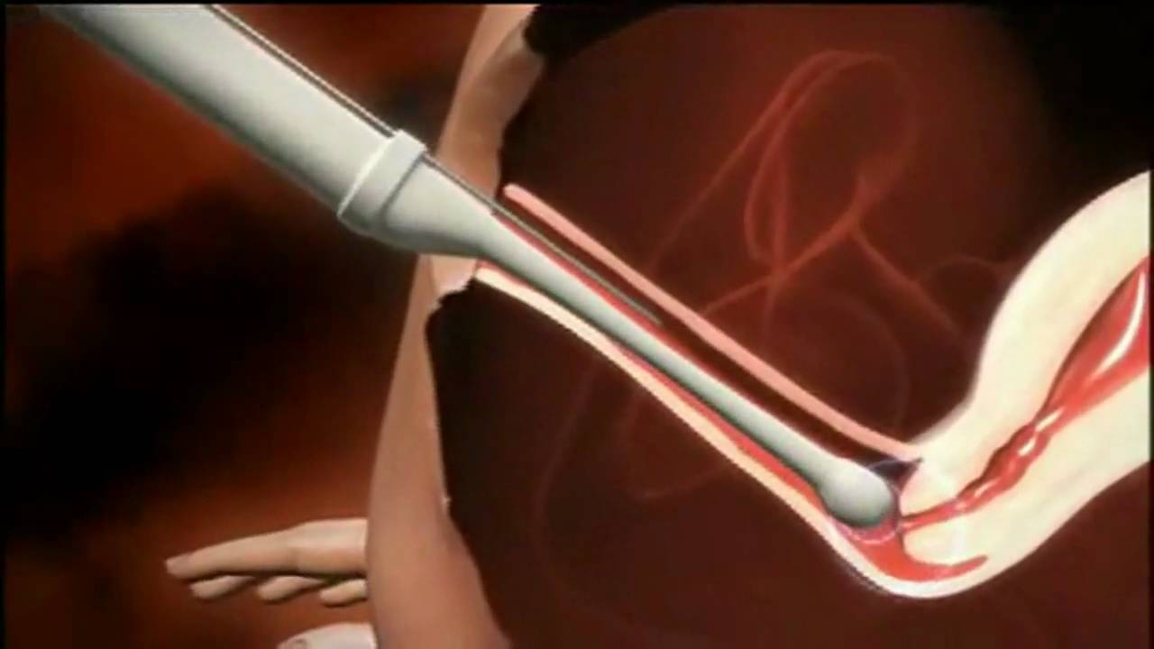 Sperm injection video