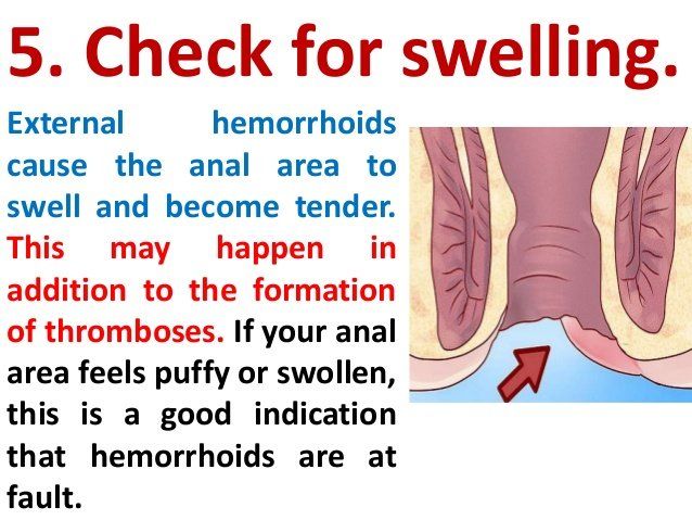 Mo reccomend External swelling anus