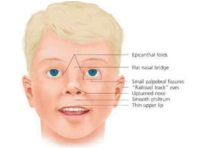 Fetal alcohol spectrum disorder facial features