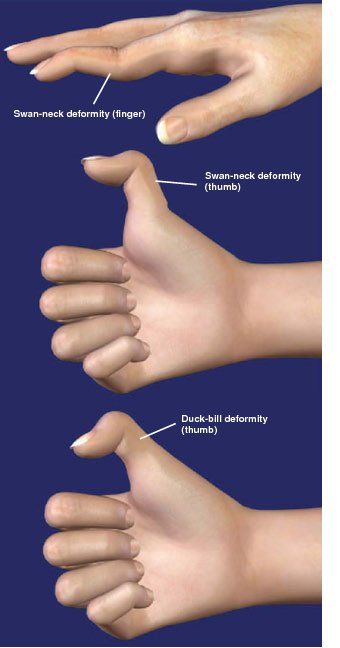 Thumb fuse orthopedic hand