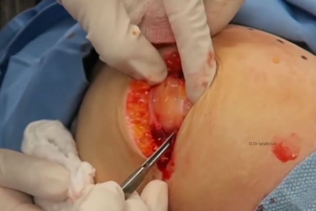 Gosling reccomend Cyst fat