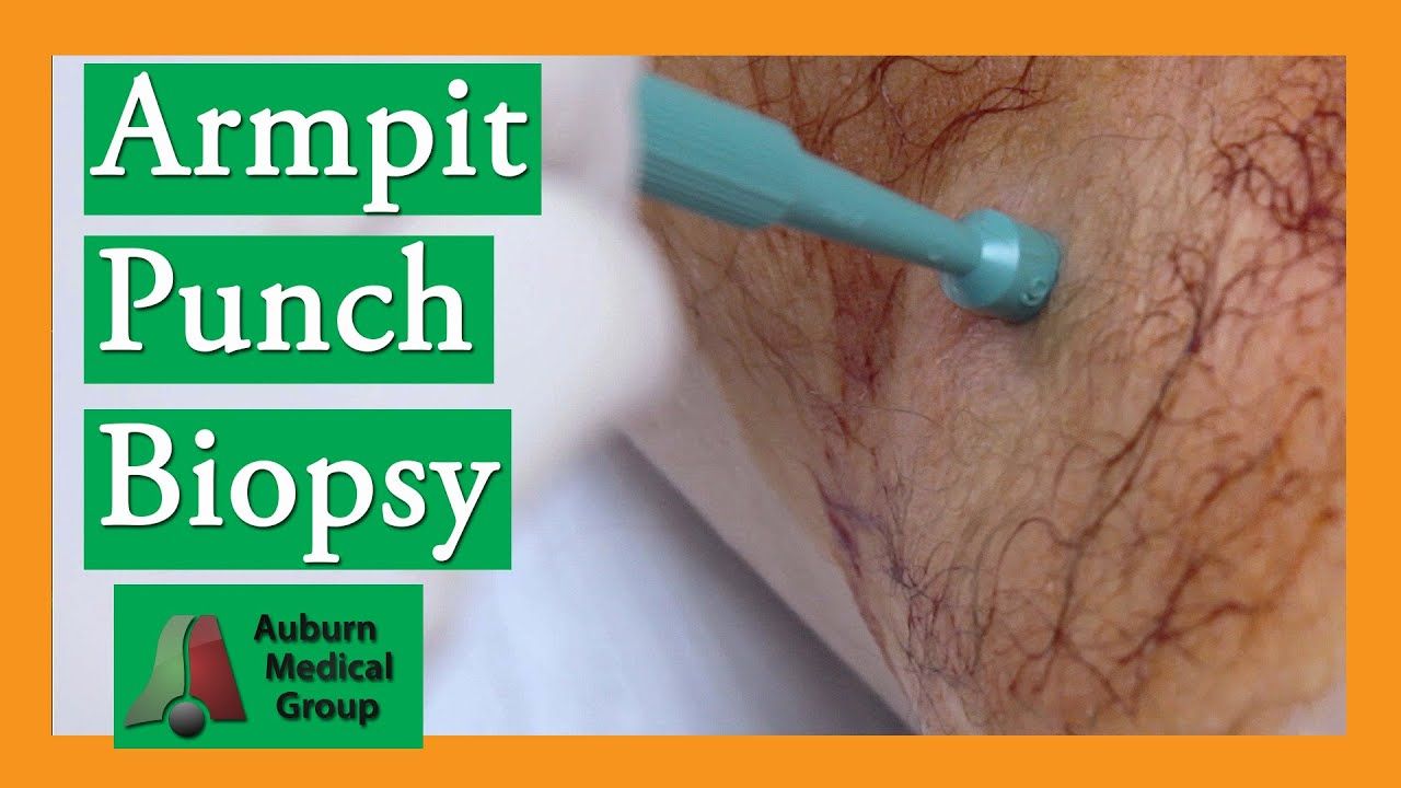 Duckling reccomend Removal of facial cysts by one stitch punch biosopy