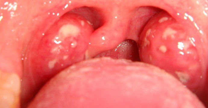 Red spots in throat after blowjob