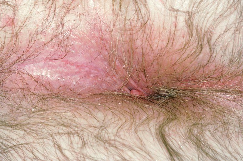 Scaly skin around anus