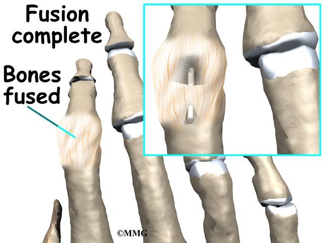 Thumb fuse orthopedic hand