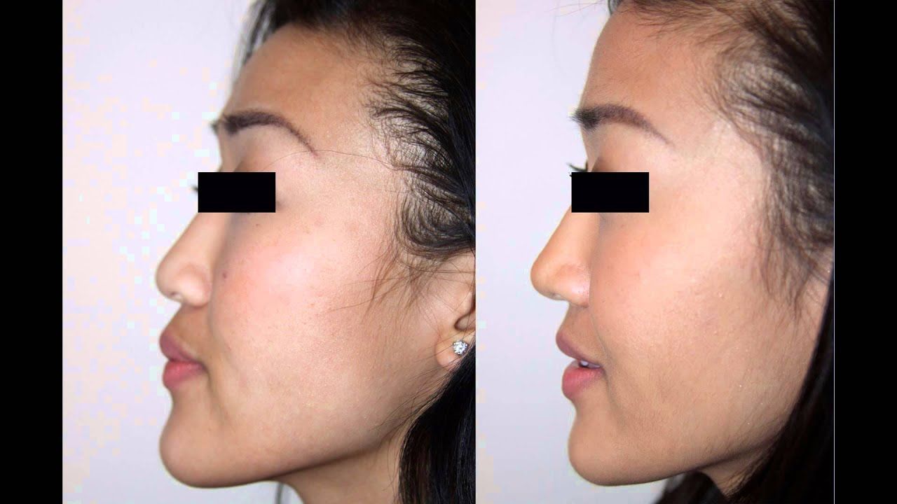 Asian rhinoplasty before after