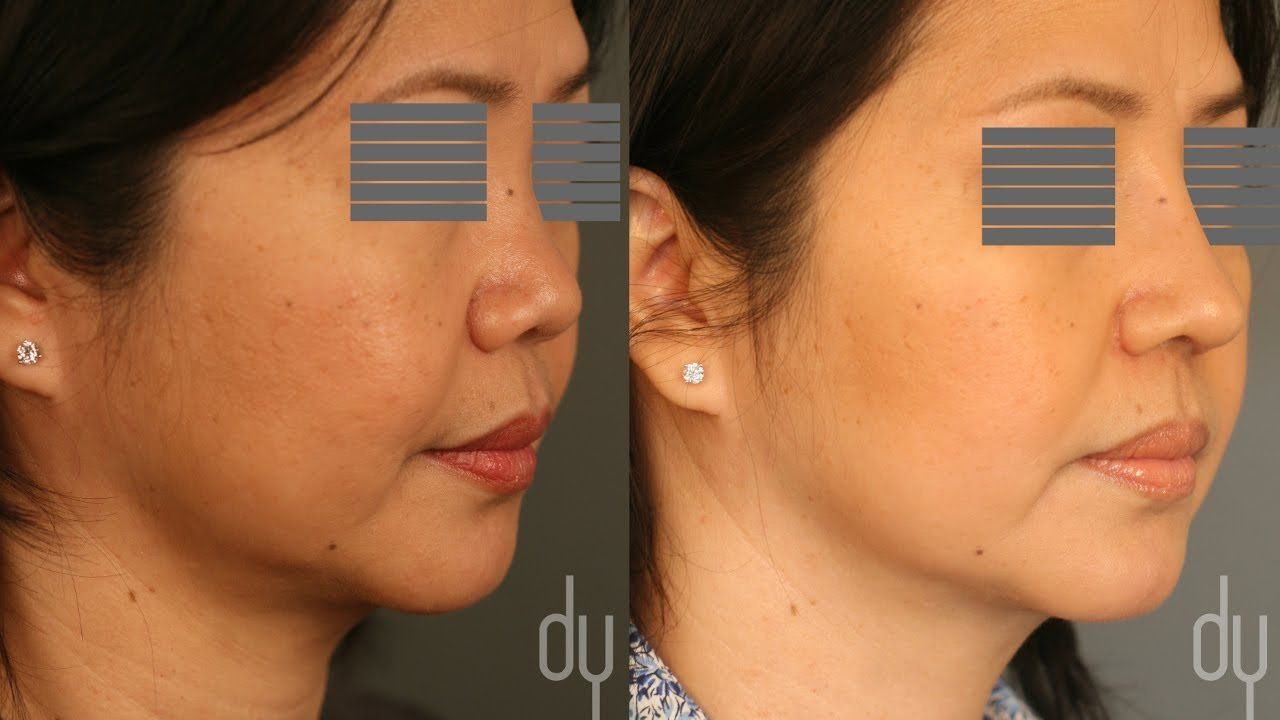 best of After before Asian rhinoplasty