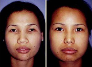 best of After before Asian rhinoplasty