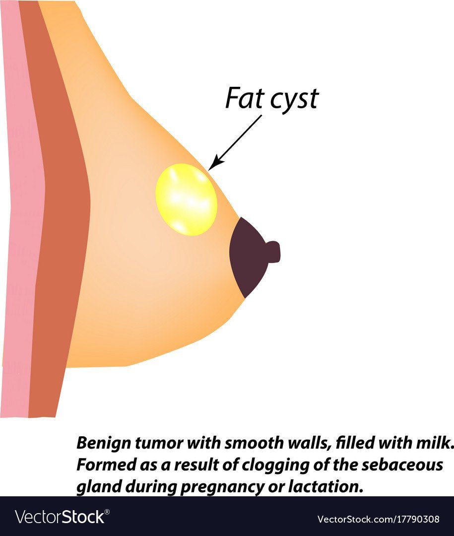 Number S. reccomend Cyst fat