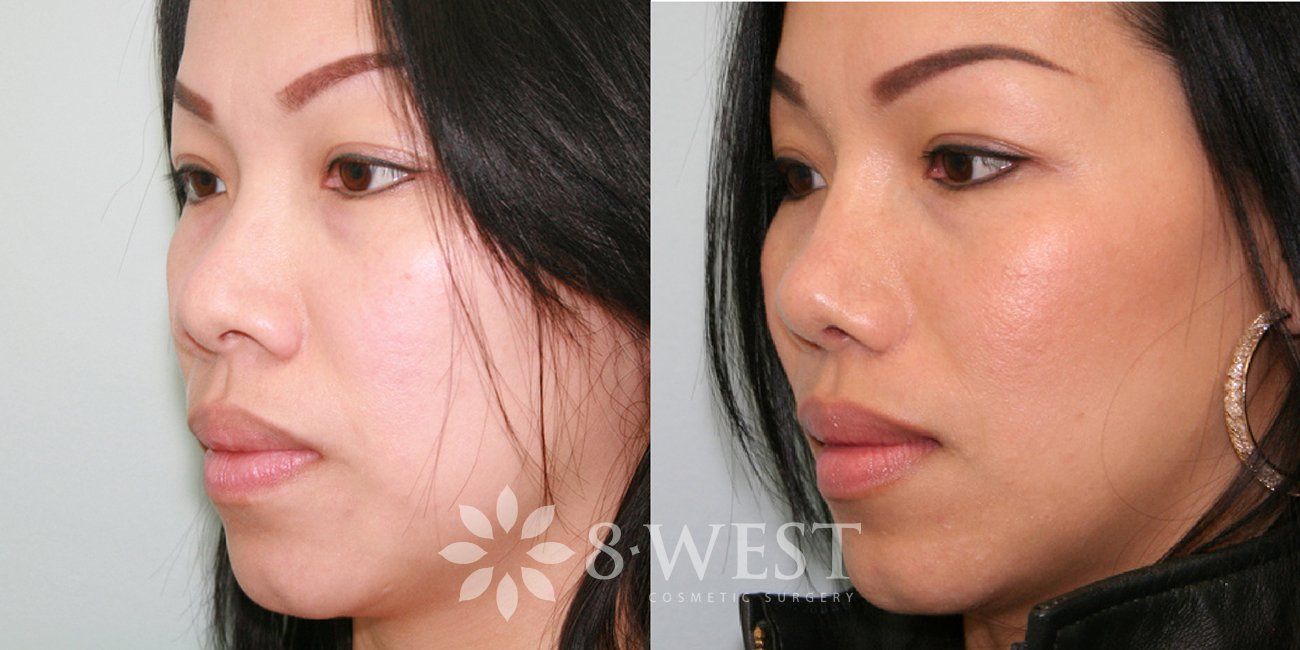 Hot C. reccomend Asian rhinoplasty before after