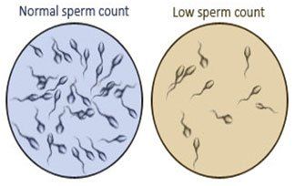 best of Sperm low Count infertility