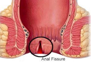 Anal fissures and thin stools