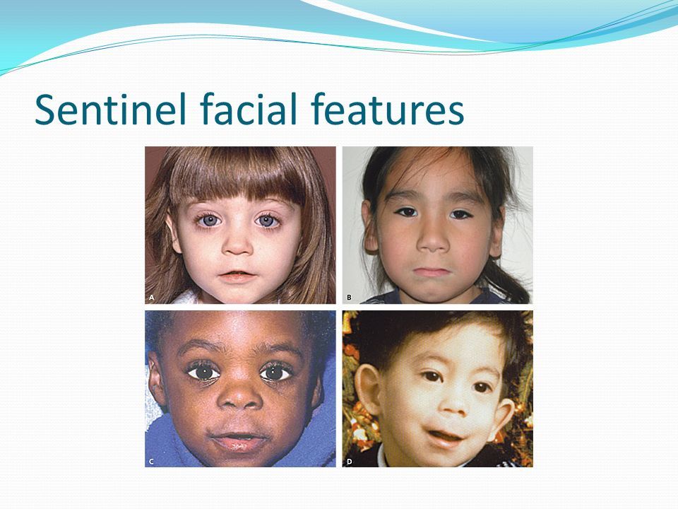 best of Features facial disorder Fetal spectrum alcohol