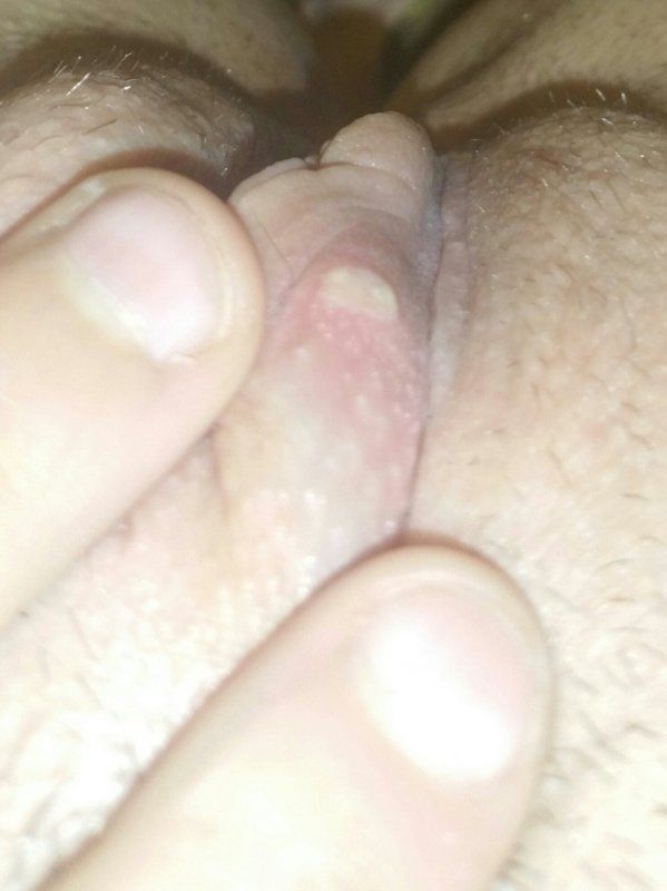 best of Is painful swollen Clitoris and