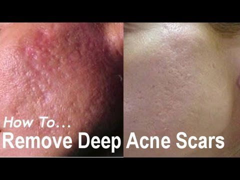 Dallas reccomend Reducing facial scarring from acne