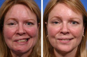 best of Reanimation surgery Facial without