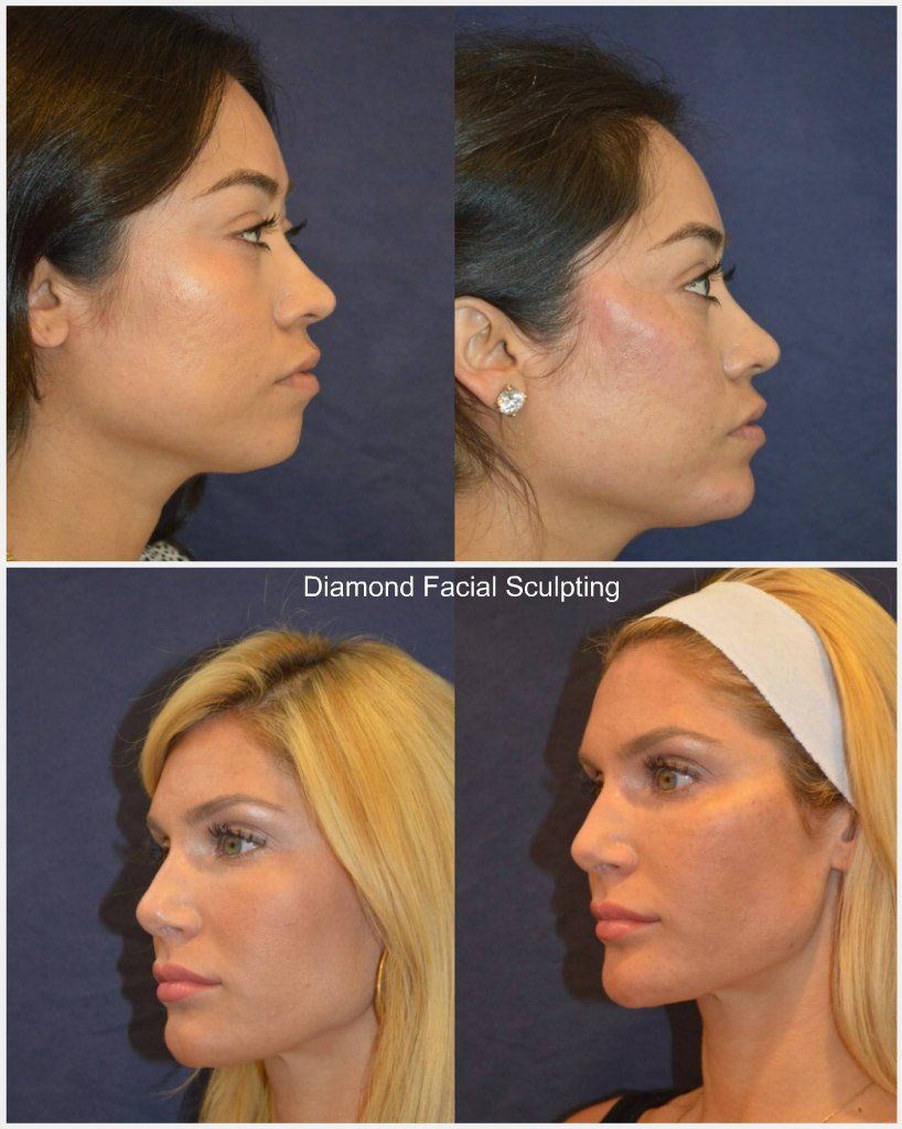 best of Surgery Facial sculpting