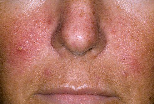 Red F. reccomend Facial spots in adults