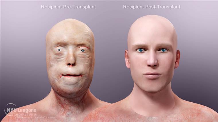 Trunk reccomend Facial transplant surgery