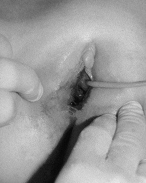 Vulva of pubescent