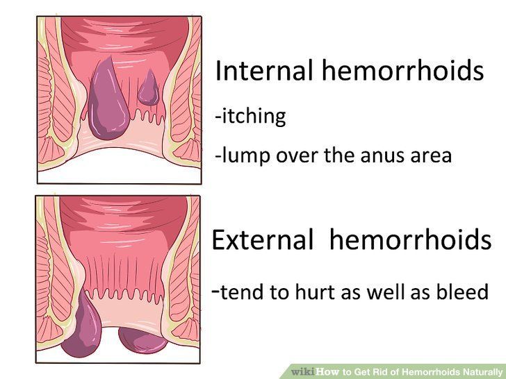 best of Hemorrhoids come like anus Feels out bubbles