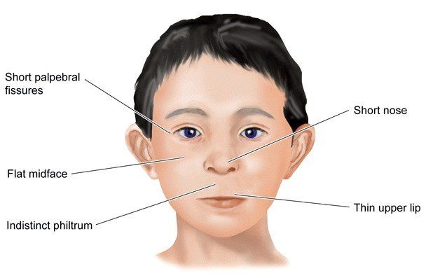 best of Features facial disorder Fetal spectrum alcohol