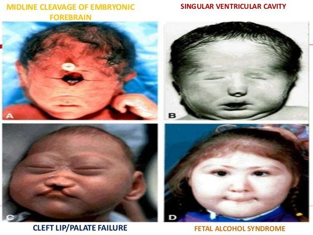 best of Alcohol diagnose facial syndrome Fetal