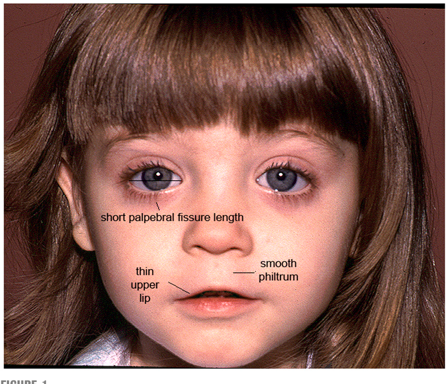 Rhubarb reccomend Fetal alcohol syndrome diagnose facial
