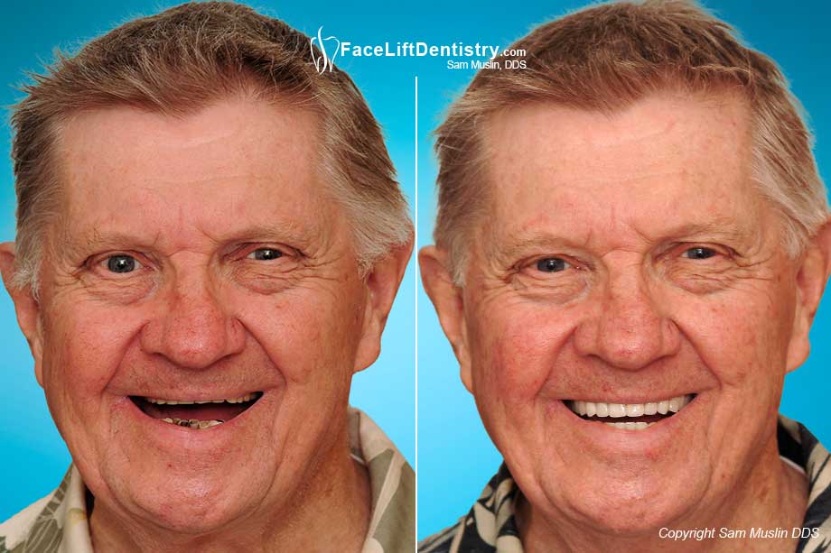 Jackal reccomend Full facial reconstruction