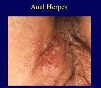 best of Anus Genital pictures herpes