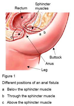 Preparing for anal surgery