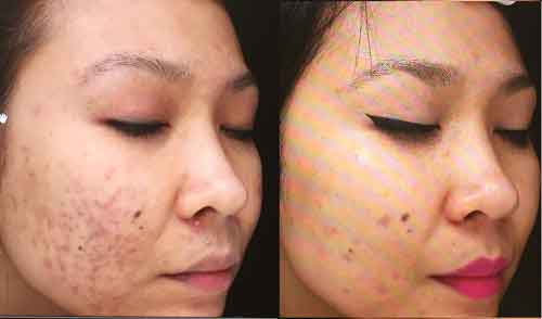 Preventing scarring after facial peel