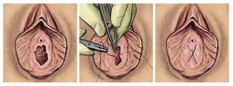 Reconstructive surgery virginity