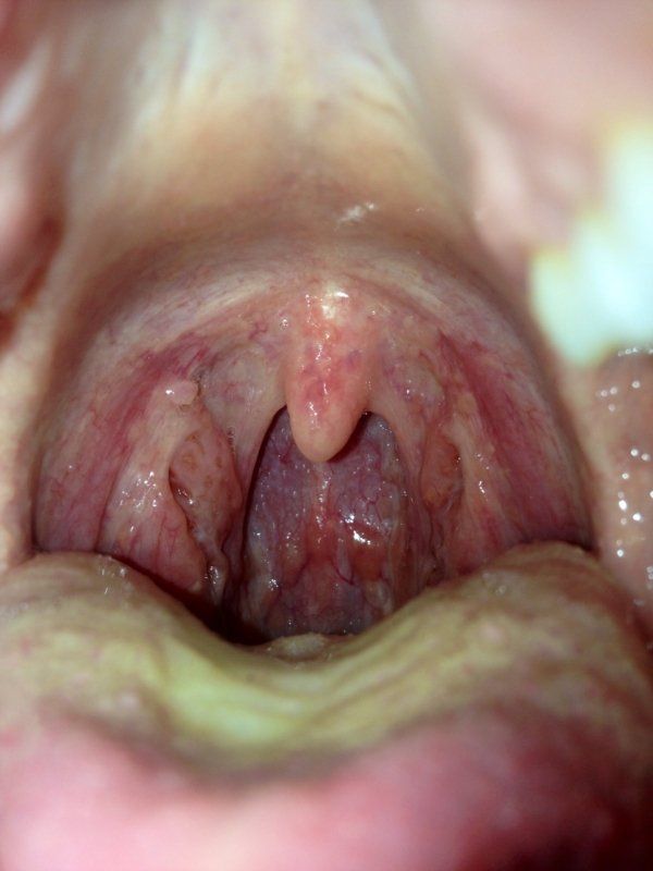 Red spots in throat after blowjob