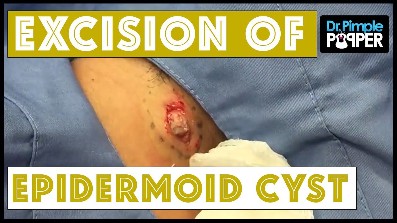 Removal of facial cysts by one stitch punch biosopy