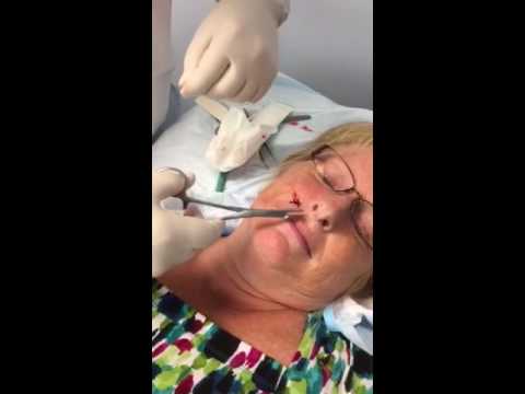 Removal of facial cysts by one stitch punch biosopy