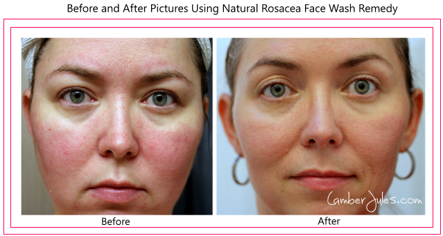 Rosacea facial cleansers