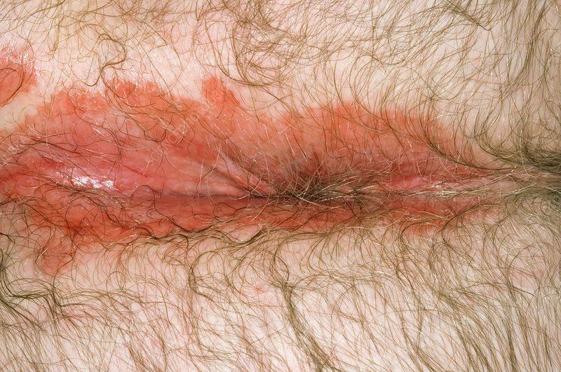 Fennel reccomend Scaly skin around anus